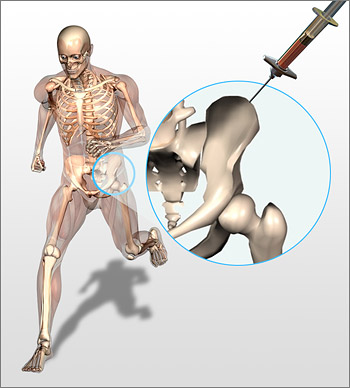 bone_marrow_draw